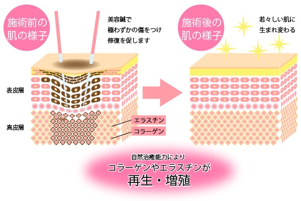 美容鍼による肌再生の様子